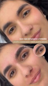 Temporal Brows (3)