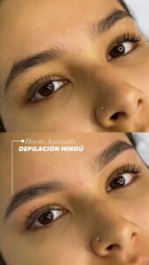 Temporal Brows (6)